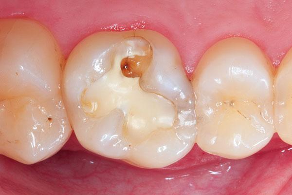 The bulk-fill technique: Economical composite-based posterior restorations