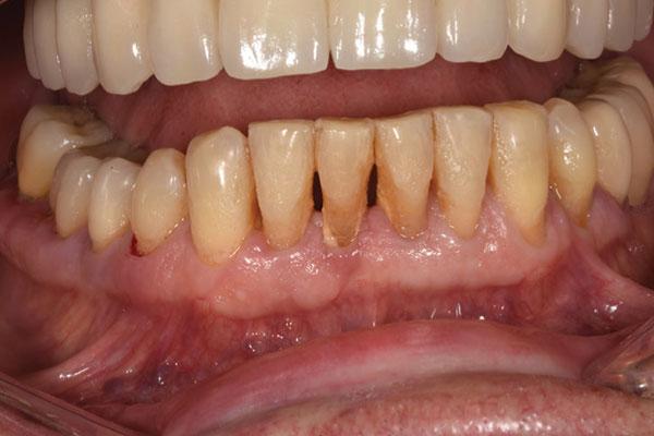 Anterior multiple implant-supported restoration